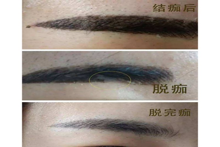 纹眉掉痂20天变化图