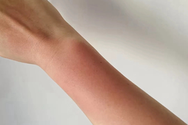 日照性皮炎胳膊红斑图