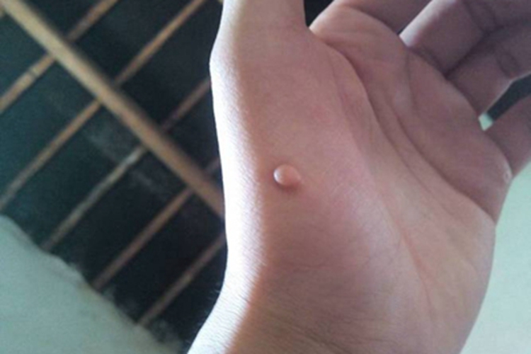 小汗腺汗孔瘤手掌症状图 小汗腺汗孔瘤手掌症状图