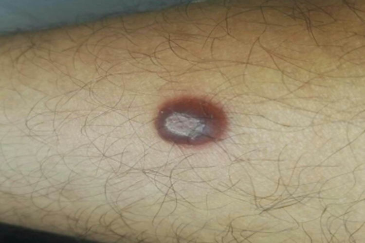 良性幼年黑色瘤小腿症状图