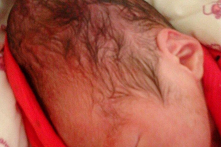 产瘤脑袋变长变形图 产瘤脑袋变长变形图