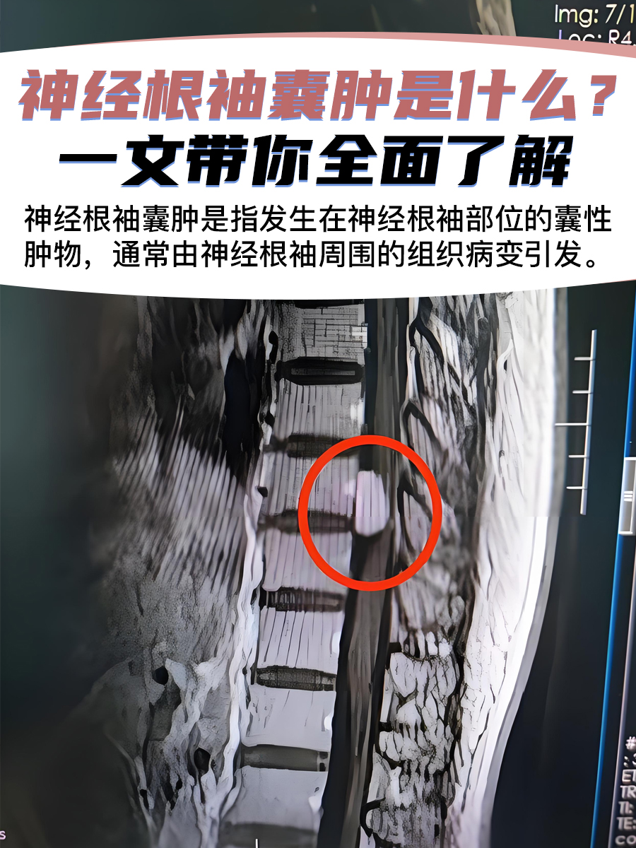 神经根袖囊肿是什么?一文带你全面了解