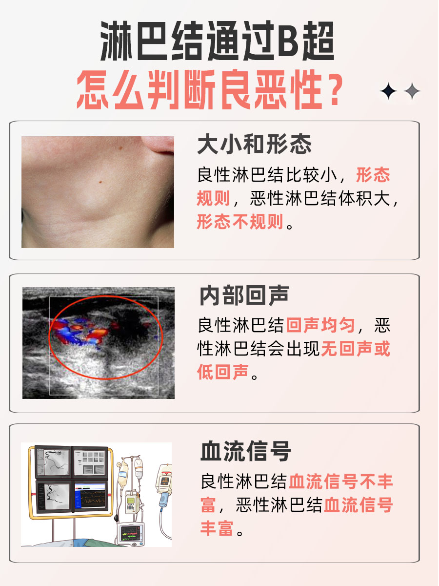 B超怎么看淋巴结的良恶性？你get到了吗