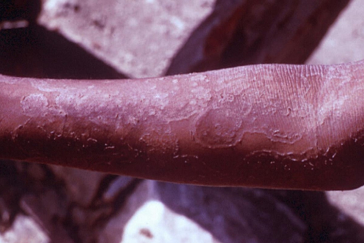 叠瓦癣胳膊症状图 叠瓦癣胳膊症状图