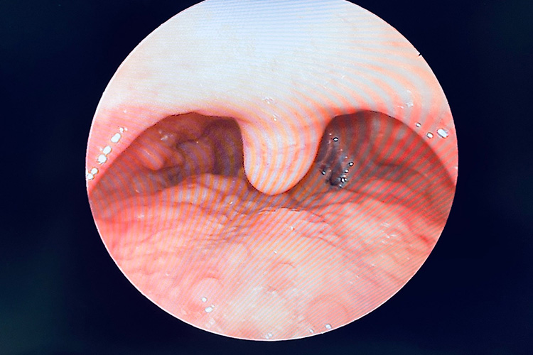 喉咙处淋巴滤泡肿大图