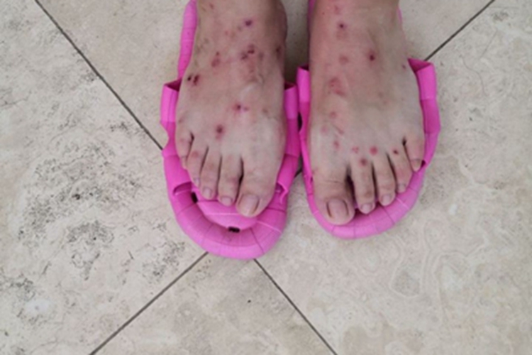 虫咬皮炎脚背结痂图