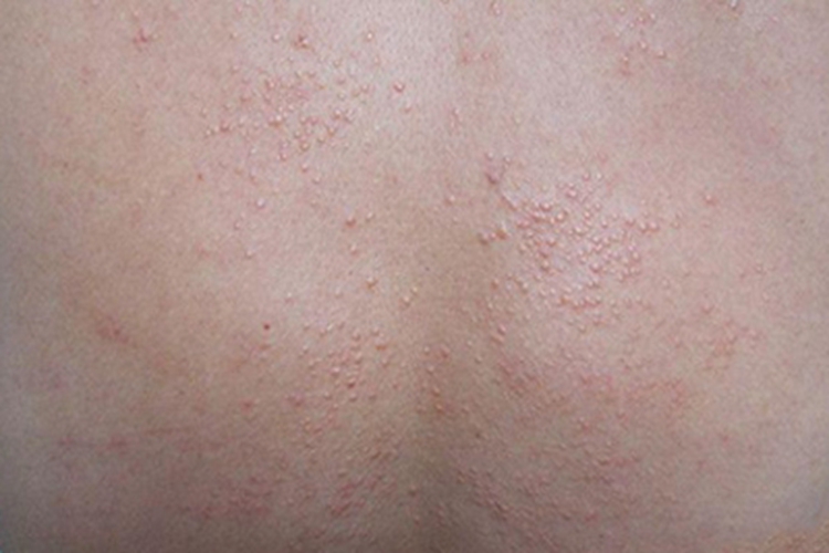 血吸虫病背部症状图