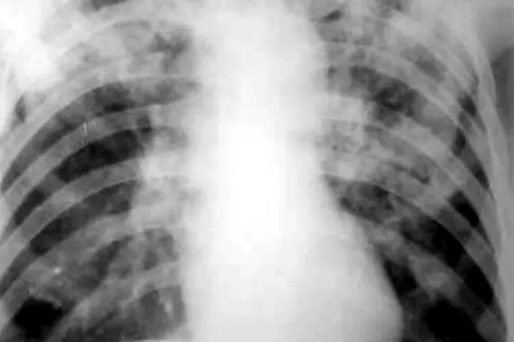 浸润型肺结核DR图 浸润型肺结核DR图