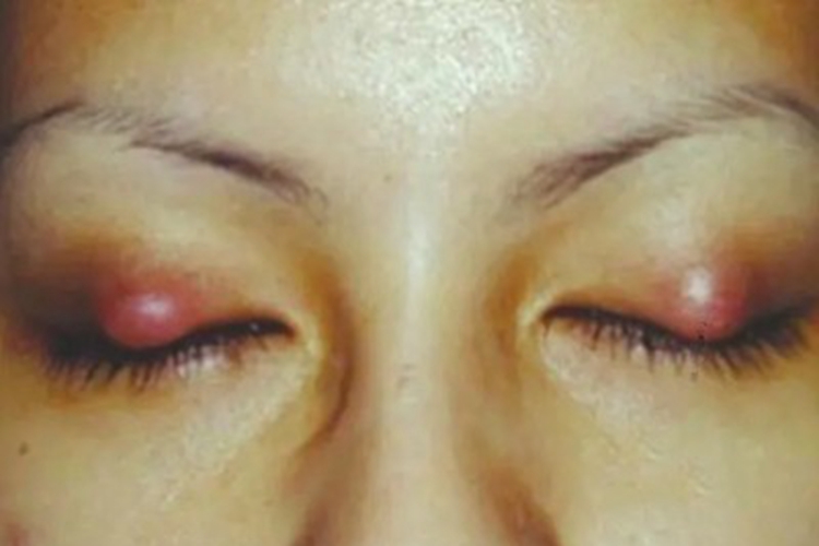 霰粒肿眼睑症状图