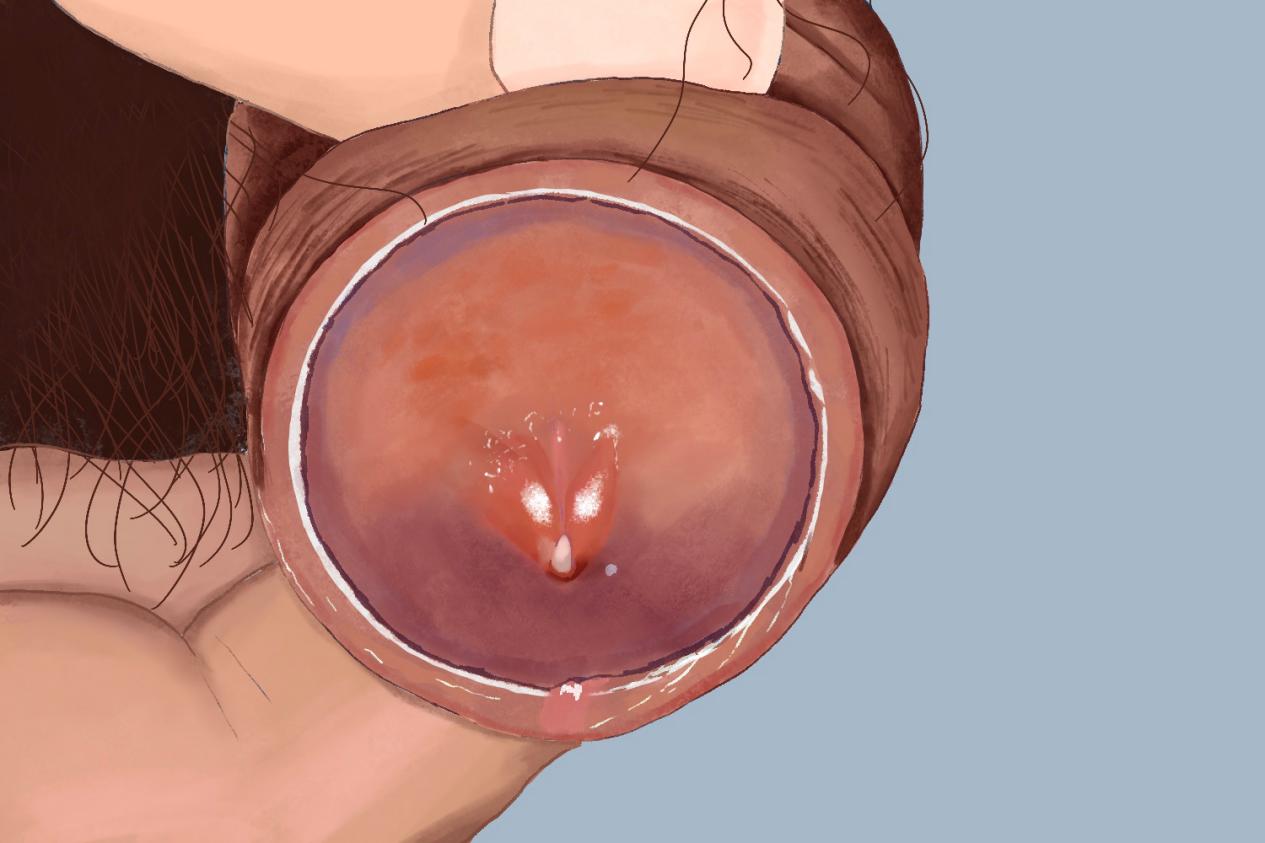 男性尿道炎尿道口一侧红肿凸起图