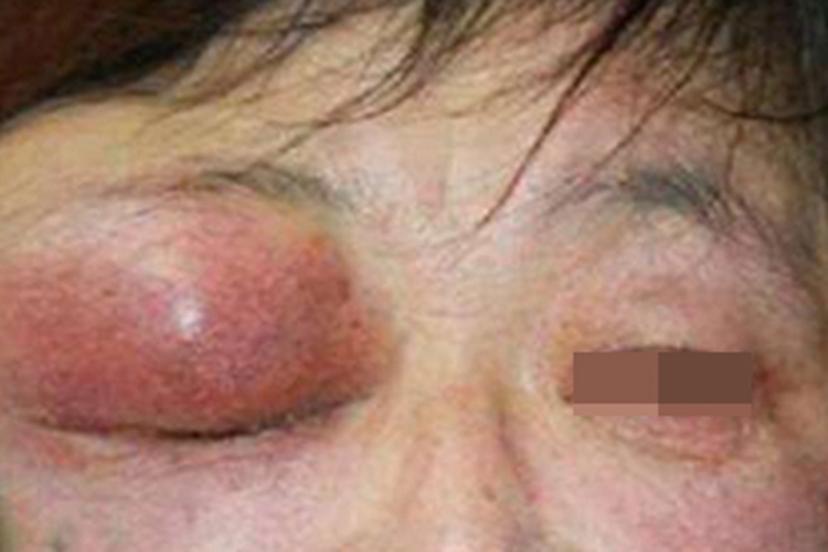 眼眶皮样囊肿大包图