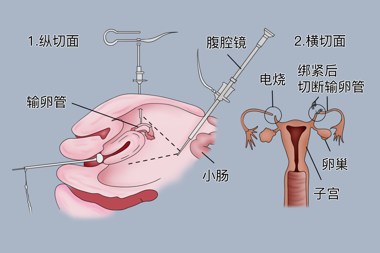 女性结扎图图片