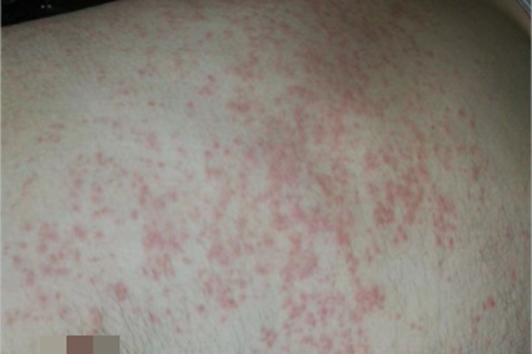 慢性湿疹腹部丘疹图