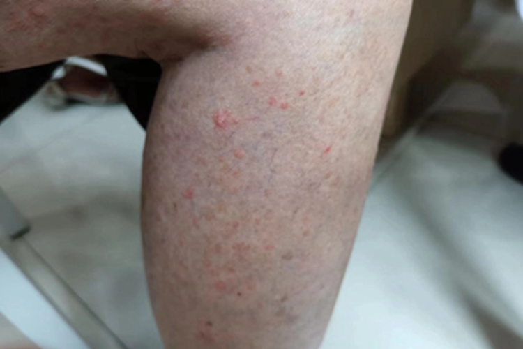 银屑病小腿小红疙瘩图 银屑病小腿小红疙瘩图