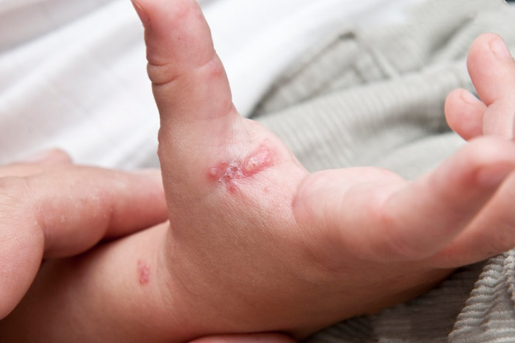 带状疱疹手指症状图 带状疱疹手指症状图