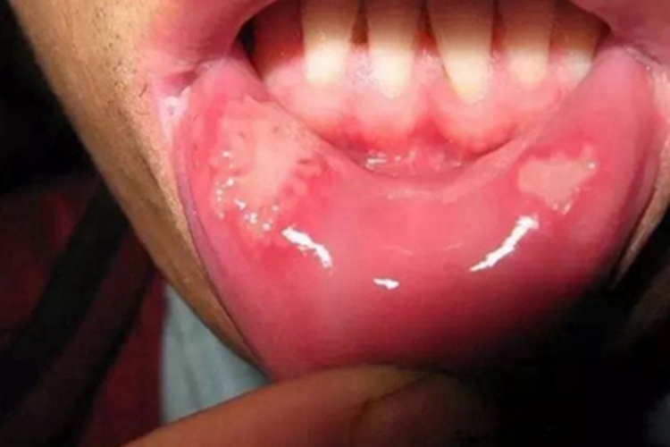 系统性红斑狼疮口腔溃疡图 系统性红斑狼疮口腔溃疡图