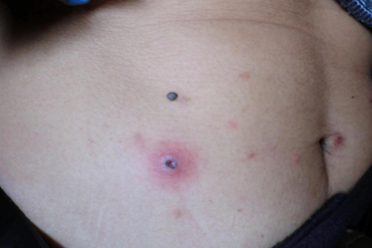 恙螨皮炎腹部结黑痂图