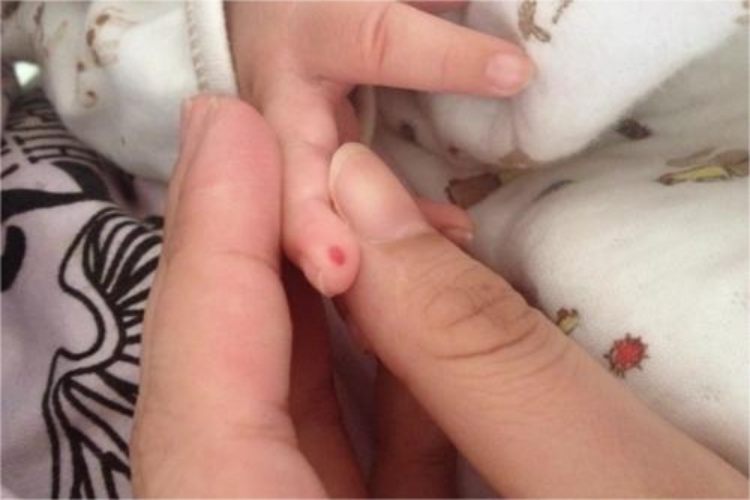 手指头上血管瘤图