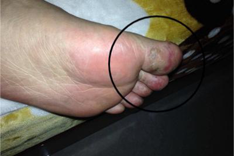 系统性红斑狼疮脚趾症状图 系统性红斑狼疮脚趾症状图