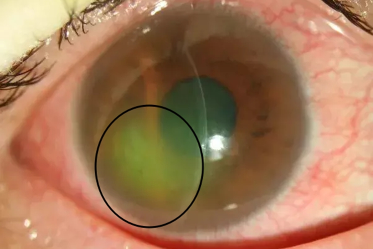 角膜上皮缺损荧光素着染图