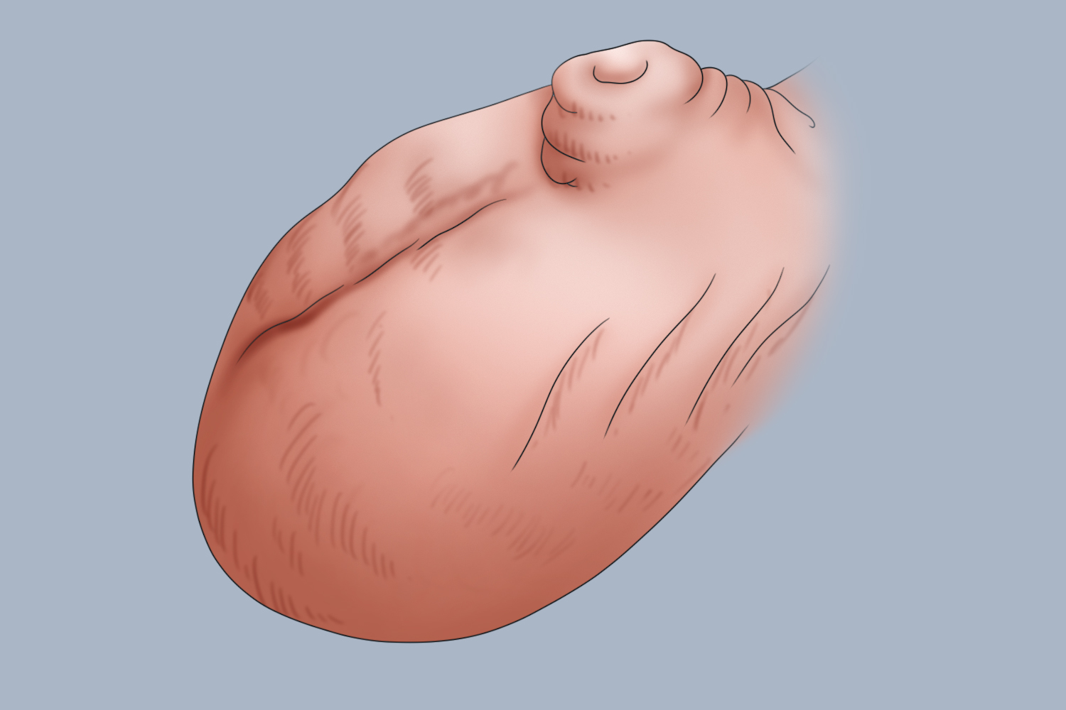 轻微的蹼状阴囊图