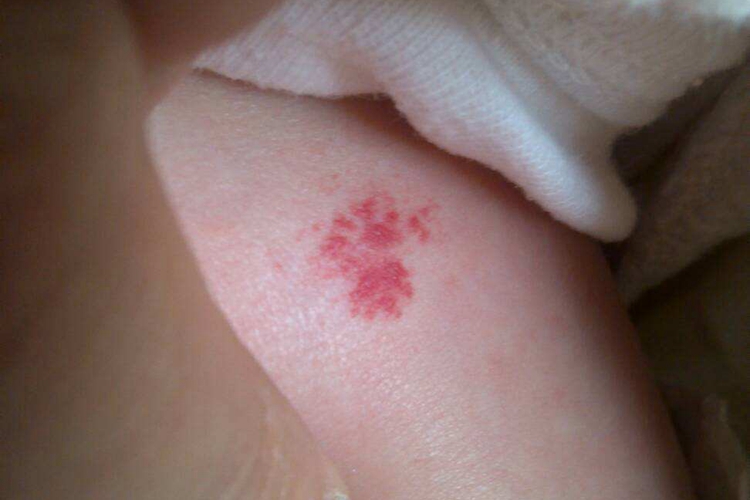 婴儿斑状血管瘤图