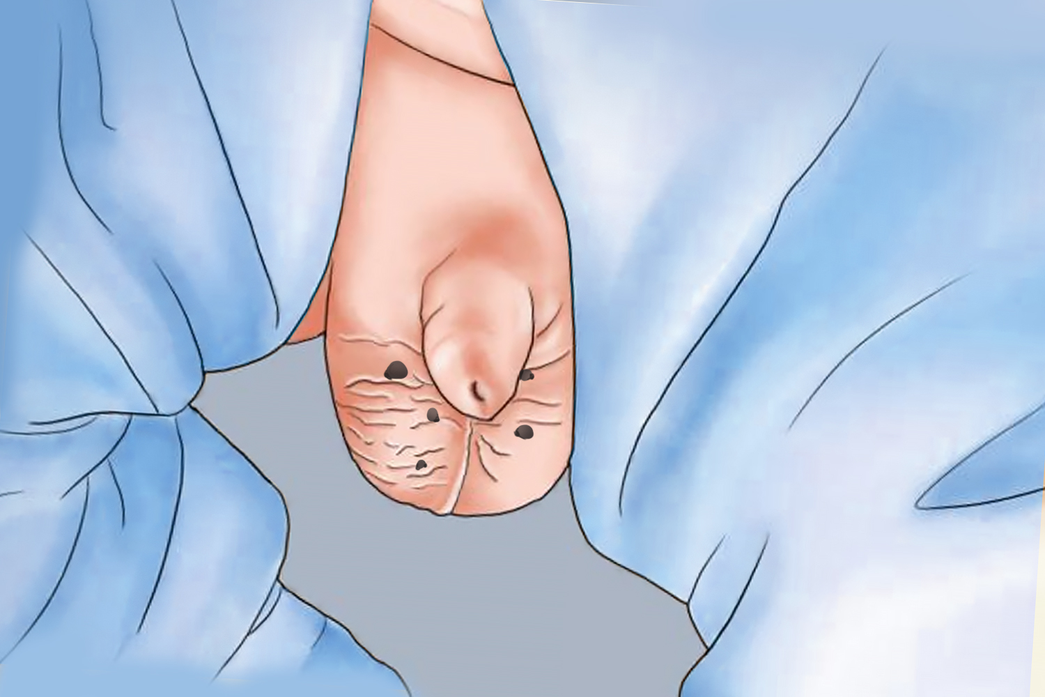 痣细胞痣图 痣细胞痣图