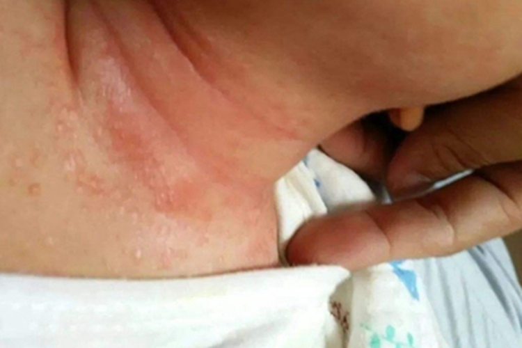 渗出型婴儿湿疹颈部红斑图