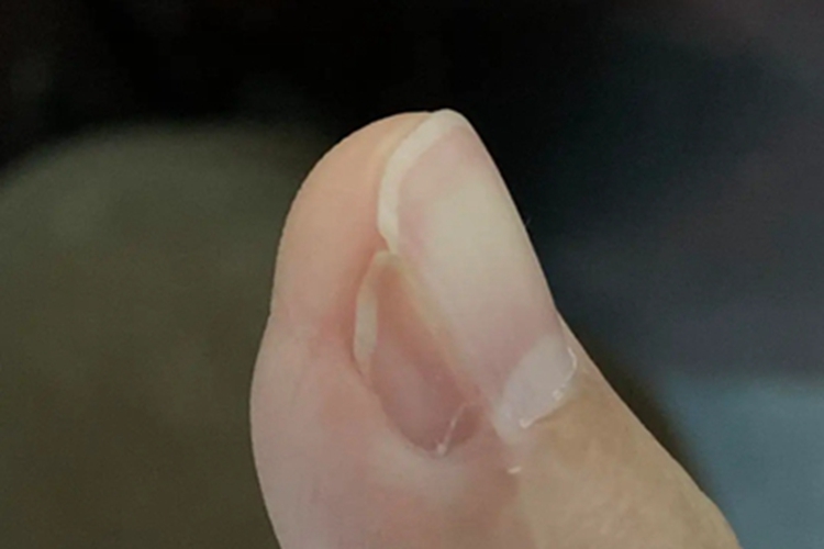 甲纵裂大拇指指甲裂了小口图