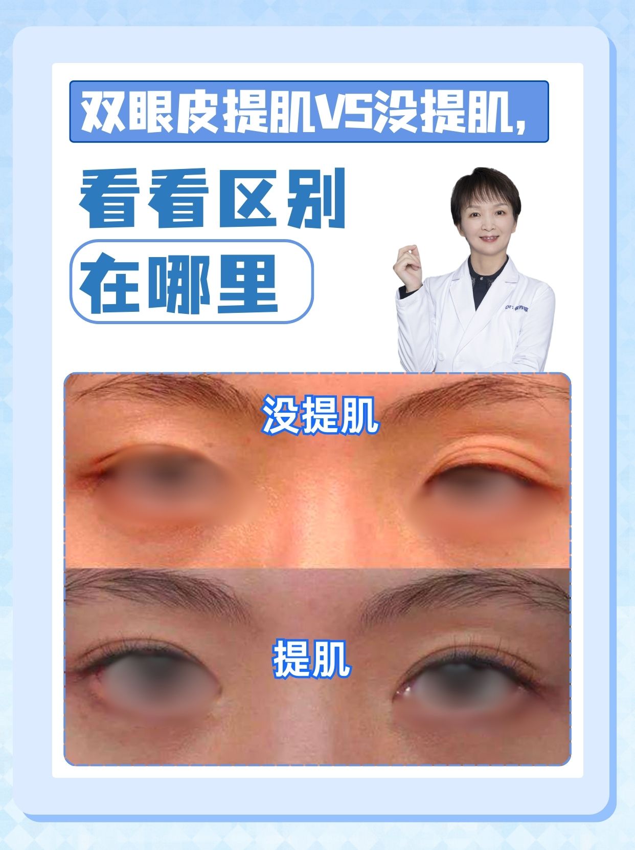 双眼皮提肌VS没提肌，看看区别在哪里
