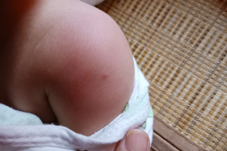 水痘疫苗不良反应红疙瘩图