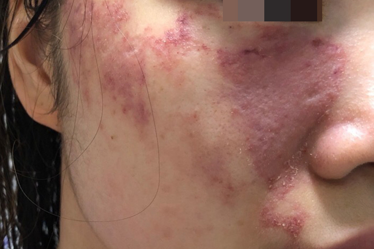 585激光后紫癜颜色较深图 585激光后紫癜颜色较深图