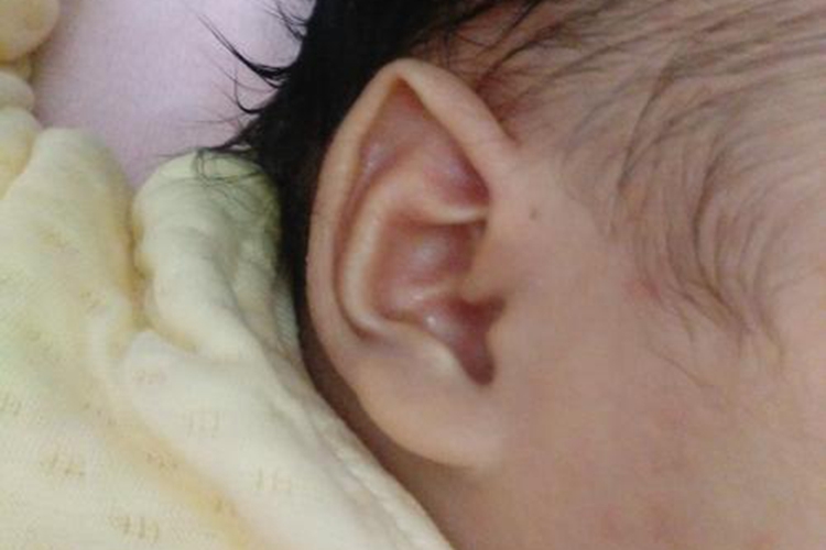 新生儿招风耳图 新生儿招风耳图