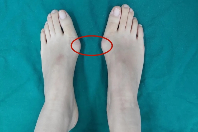 拇外翻的下方骨头凸起图 拇外翻的下方骨头凸起图