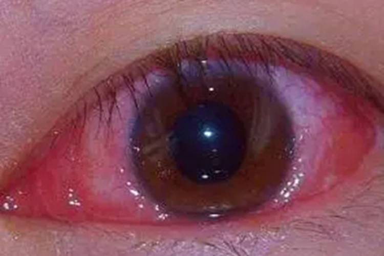 超急性细菌性结膜炎眼部充血图