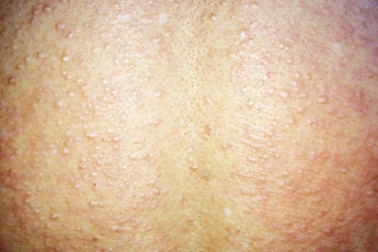 孤立丘疹型局限性黏液水肿性苔藓图