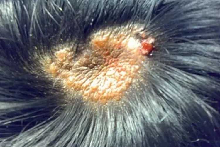 乳头状汗管囊腺瘤头皮肿块图 乳头状汗管囊腺瘤头皮肿块图