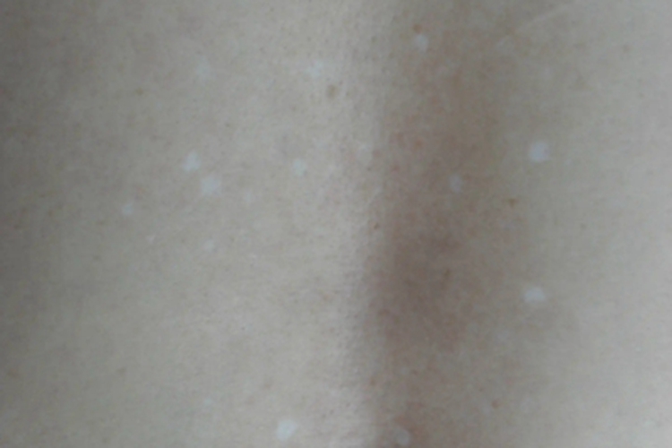 特发性滴状色素减少症背部圆点图