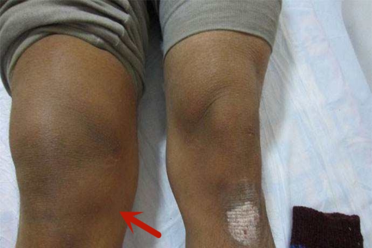 膝关节内侧肿大图