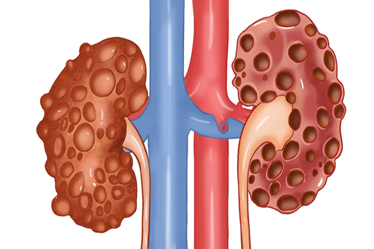 多囊肾图