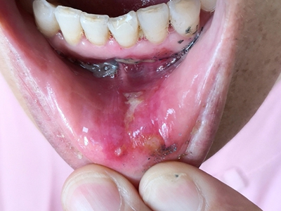 艾滋病人的嘴角图片图片