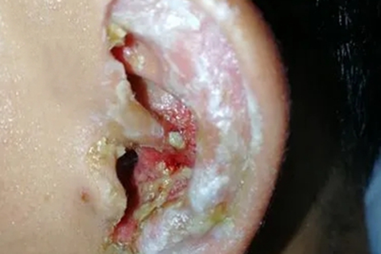 急性外耳道炎图 急性外耳道炎图