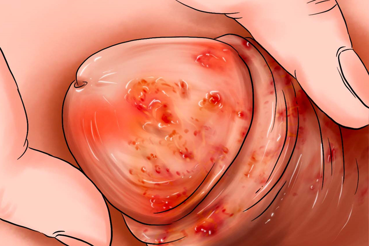 滴虫性龟头炎包皮手绘图 滴虫性龟头炎包皮手绘图