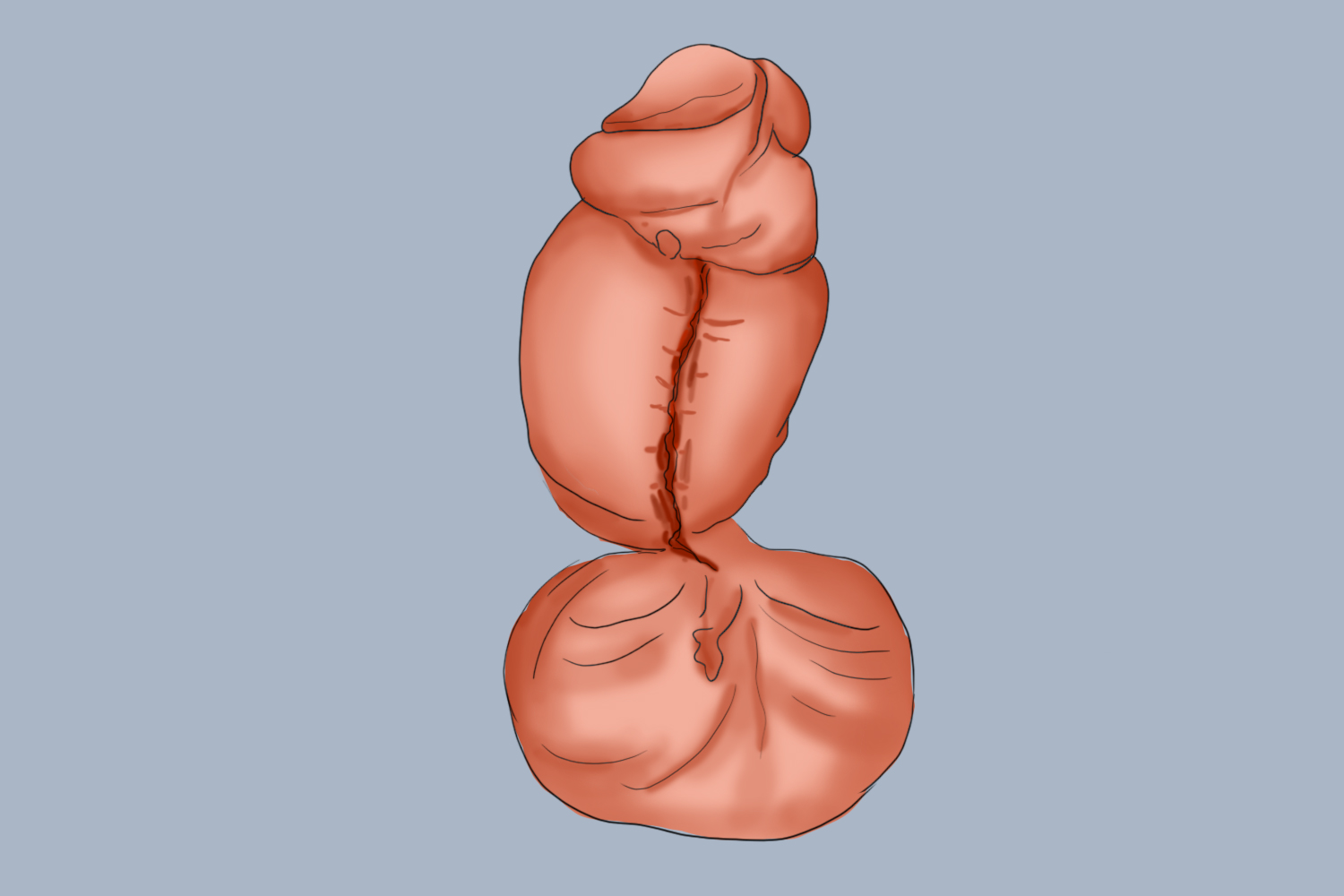 蹼状阴茎手术后图 蹼状阴茎手术后图