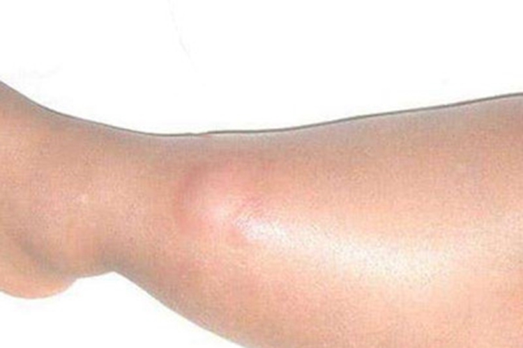 滑膜肉瘤小腿症状图