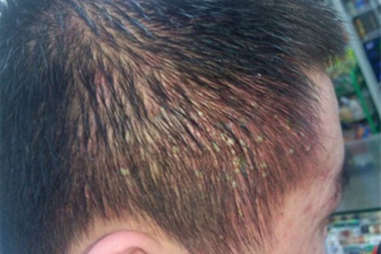 白塞病头皮发红表面有脓包图