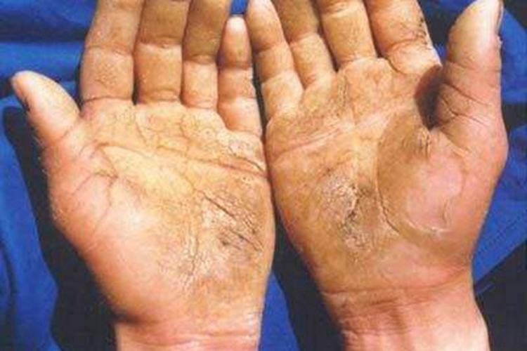 进行性掌跖角化病手掌皲裂图 进行性掌跖角化病手掌皲裂图