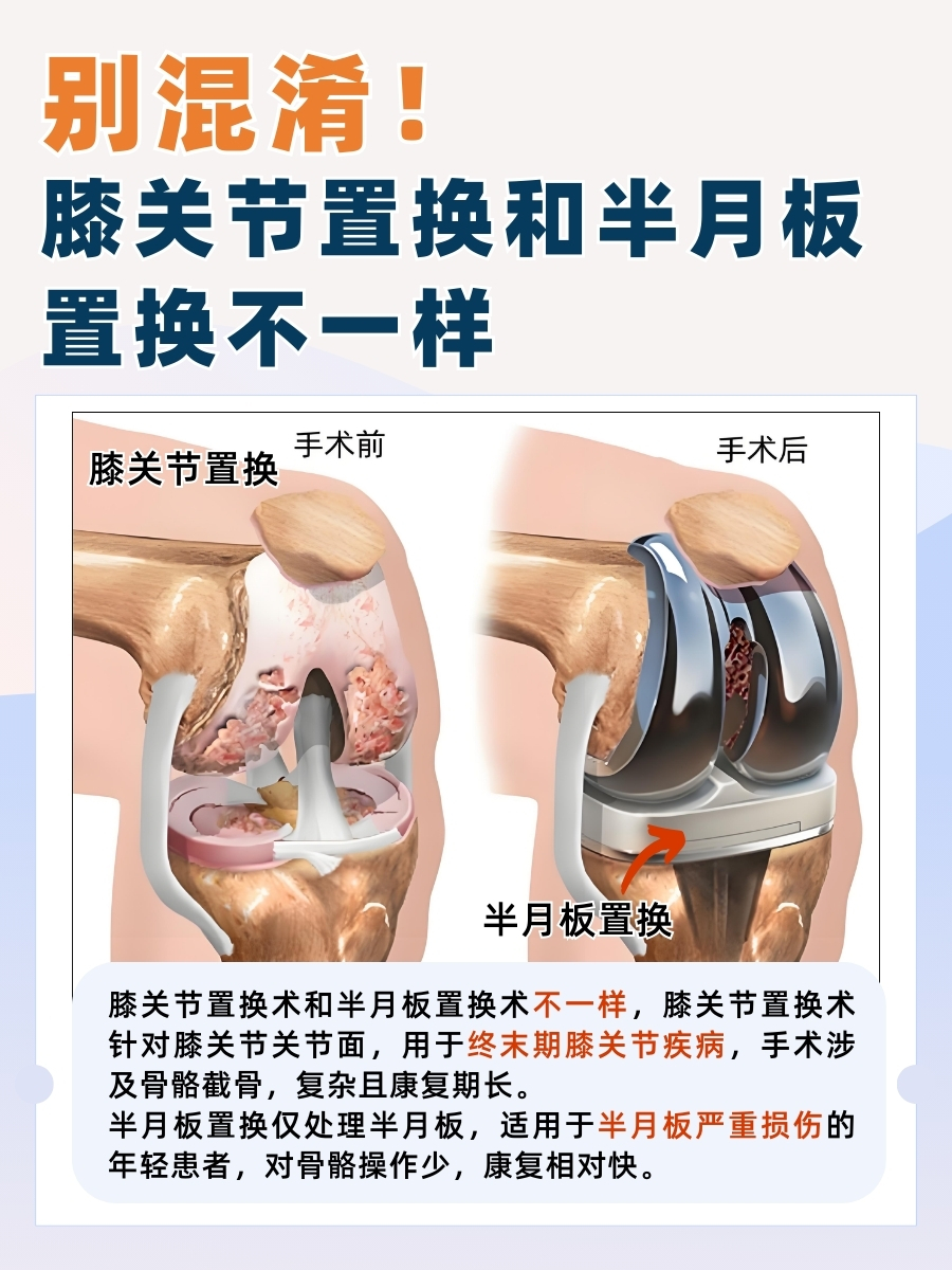 别混淆!膝关节置换和半月板置换不一样