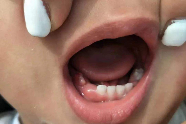 正常萌出牙床鼓包图