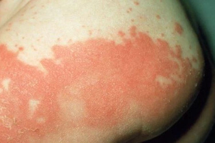 婴儿尿布皮炎弥漫红斑图